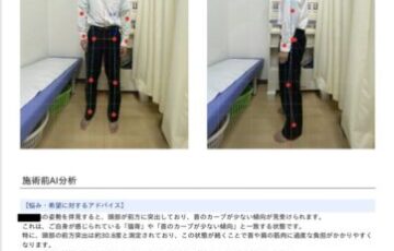 牛久市の接骨院でストレートネックの傾き角度をAI姿勢解析する画面
