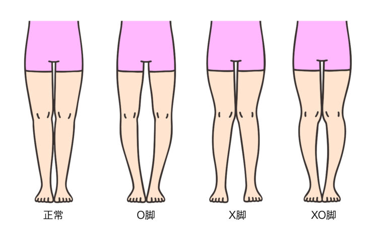 脚部アライメントの比較イラスト：両膝とくるぶしが接して一直線に伸びる『正常な脚』、両くるぶしを揃えると膝の間に隙間が開く『O脚（内反膝）』、両膝は接するがくるぶしが離れる『X脚（外反膝）』、太ももと膝は接するが膝下が外側に開く『XO脚（膝下O脚）』の4つの特徴を示した図